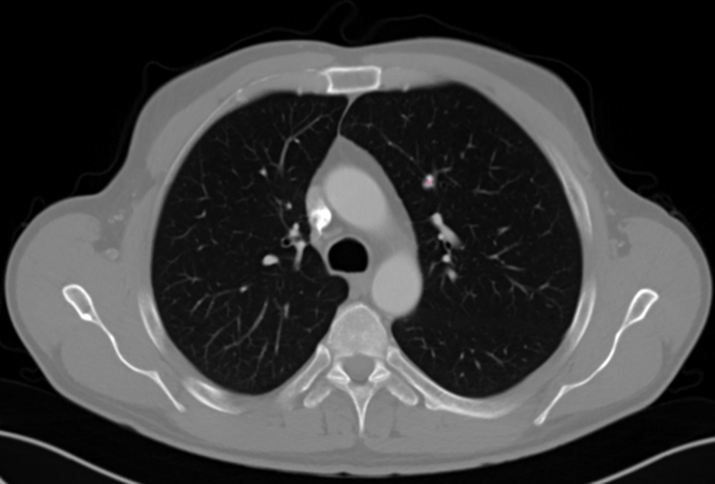 Original CT (Computed Tomography) Aorta