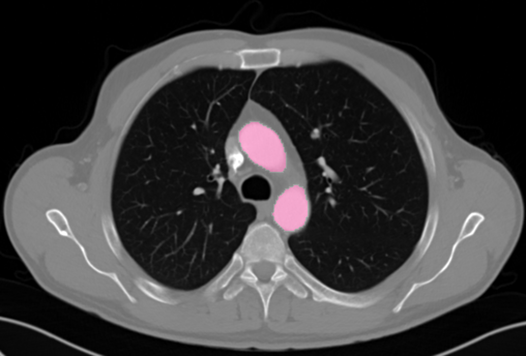 Segmented CT (Computed Tomography) Aorta