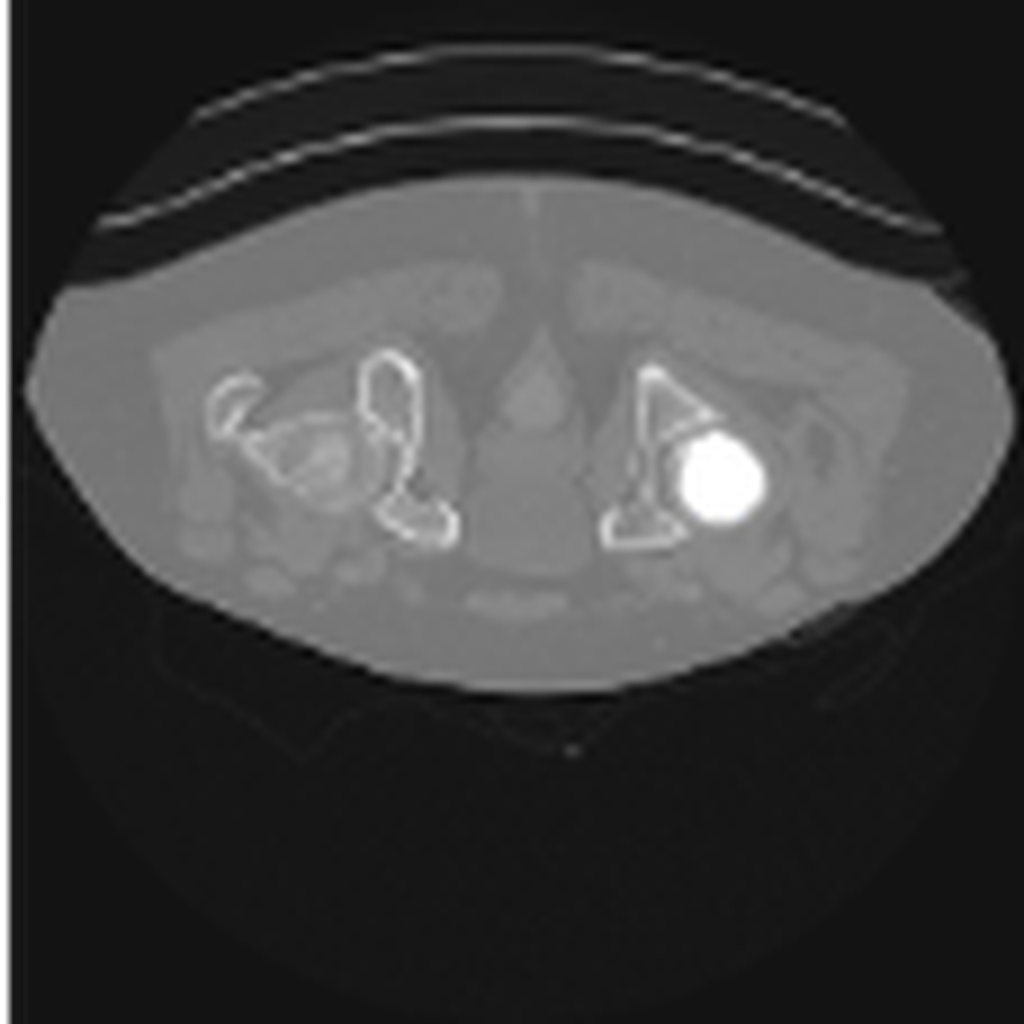 Original CT (Computed Tomography) Pelvic