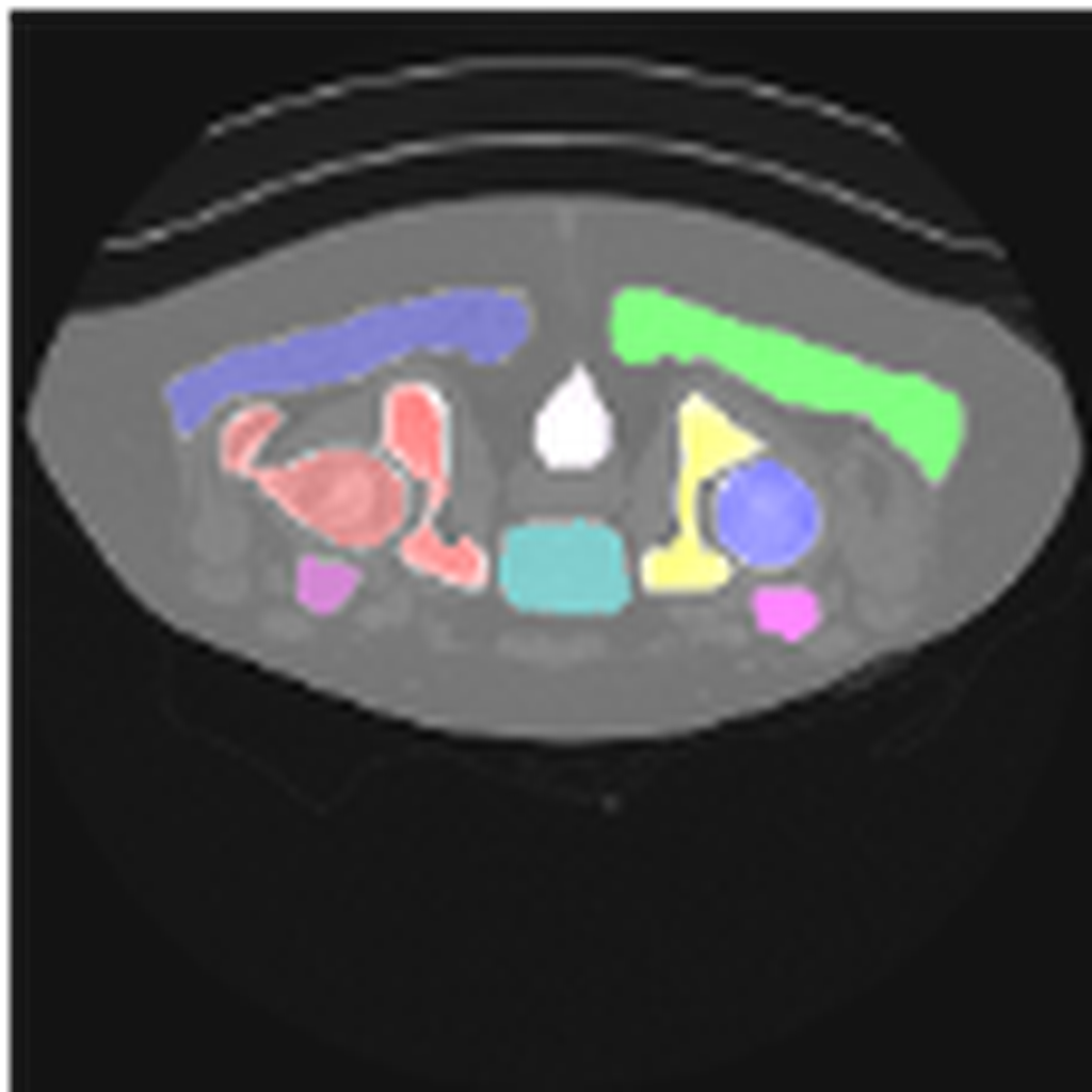 Segmented CT (Computed Tomography) Pelvic