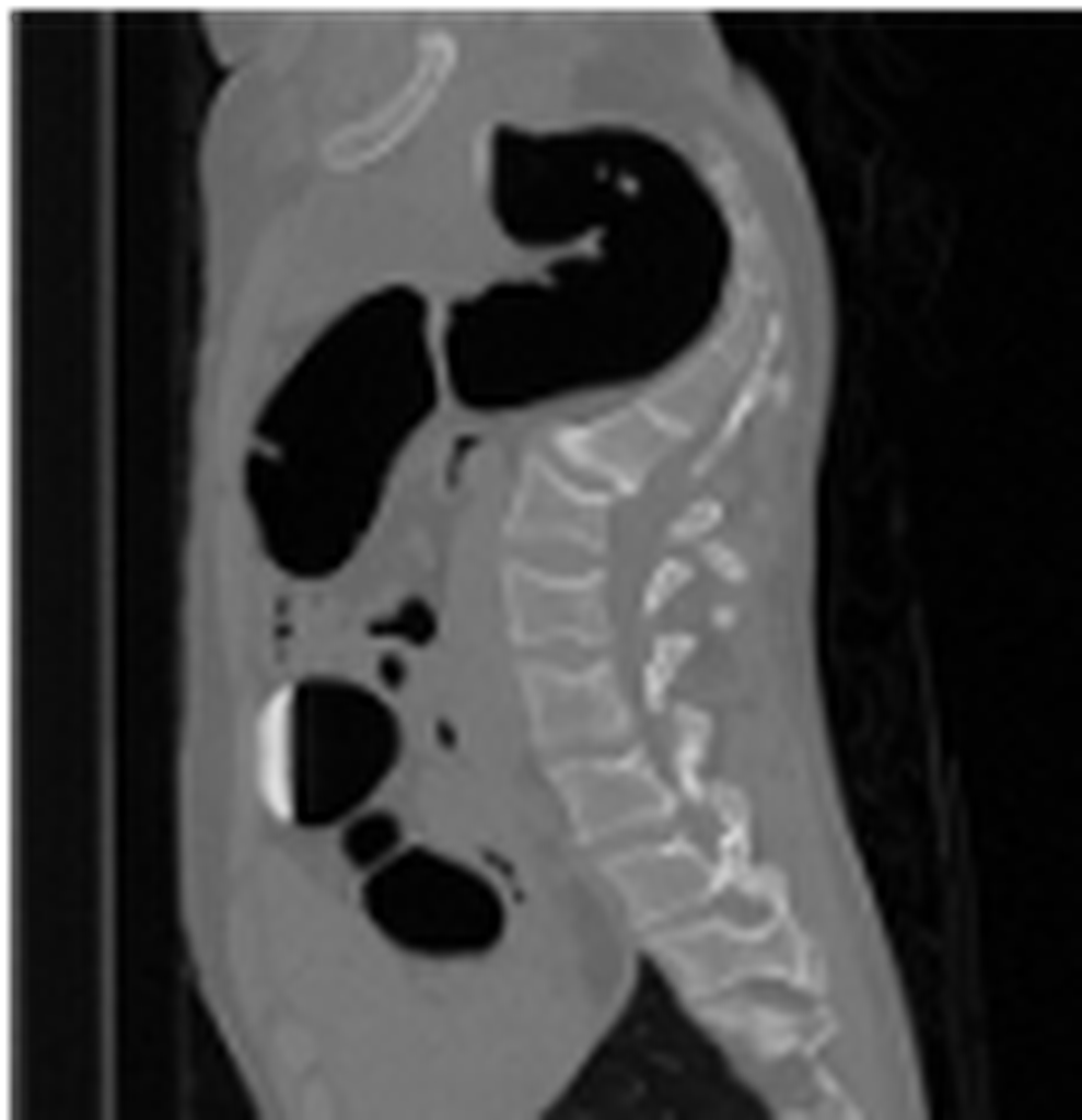 Original CT (Computed Tomography) Spine