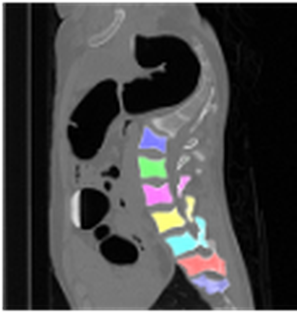 Segmented CT (Computed Tomography) Spine