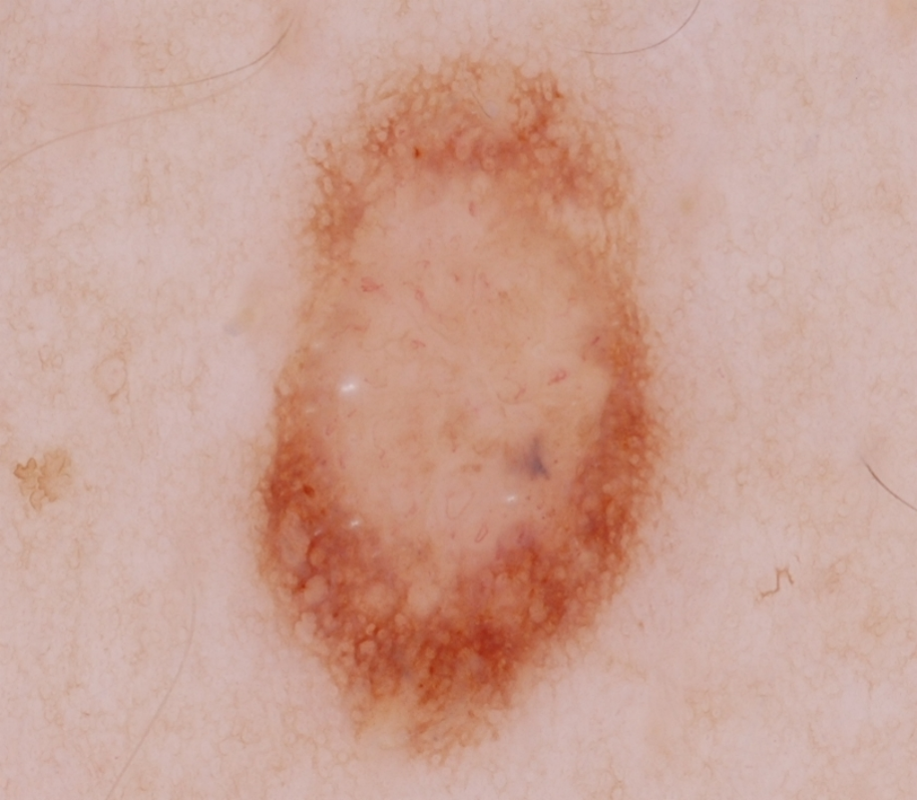 Original Dermoscopy Skin Lesion