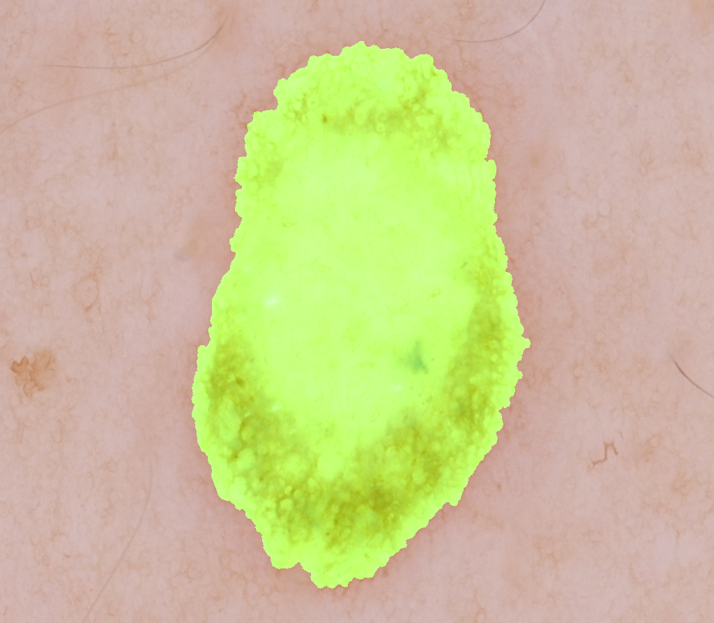 Segmented Dermoscopy Skin Lesion