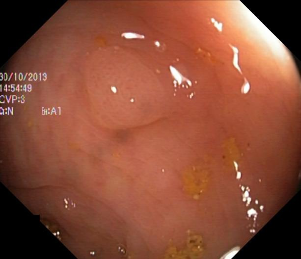 Original Endoscopy Polyp