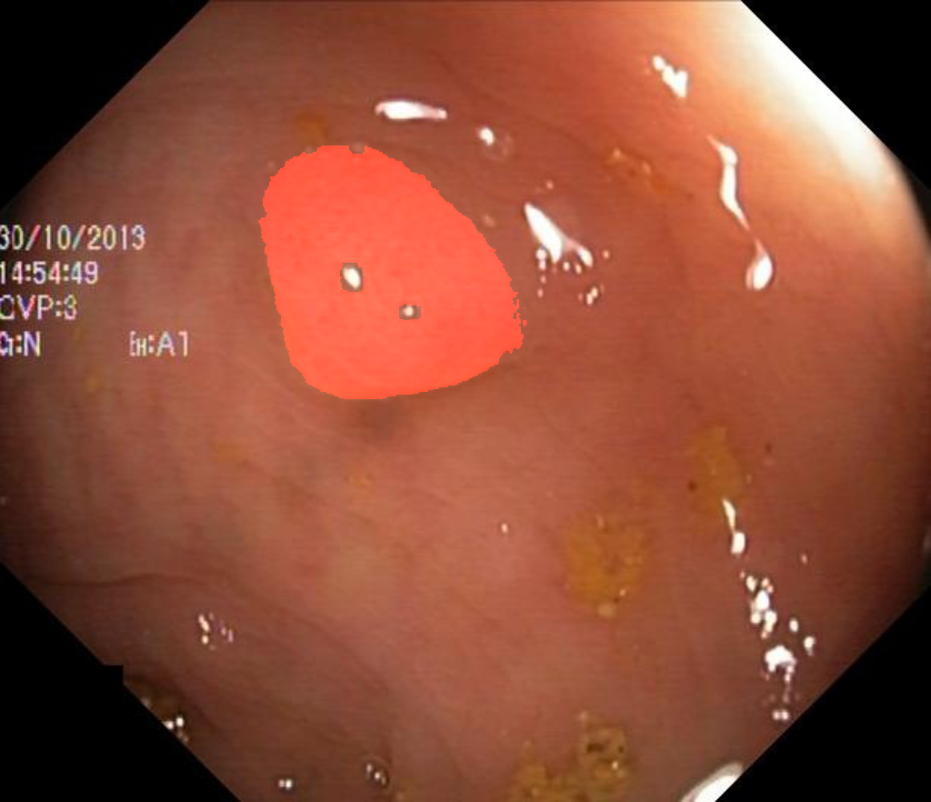 Segmented Endoscopy Polyp
