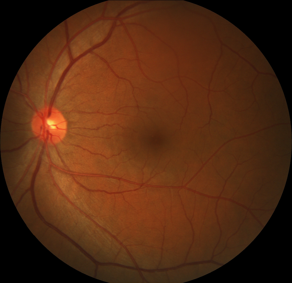 Original Fundus Photography Lesion