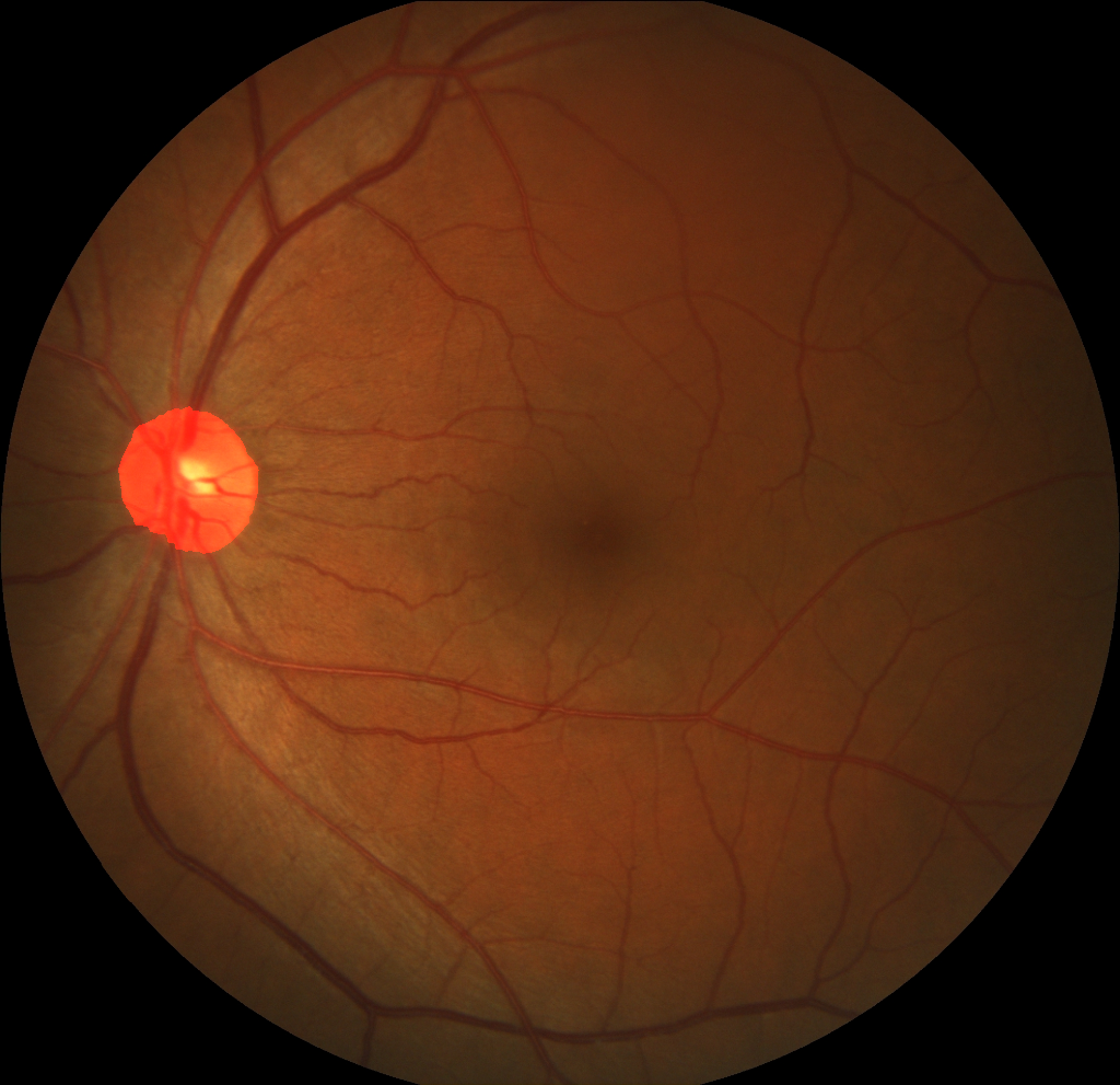Segmented Fundus Photography Lesion