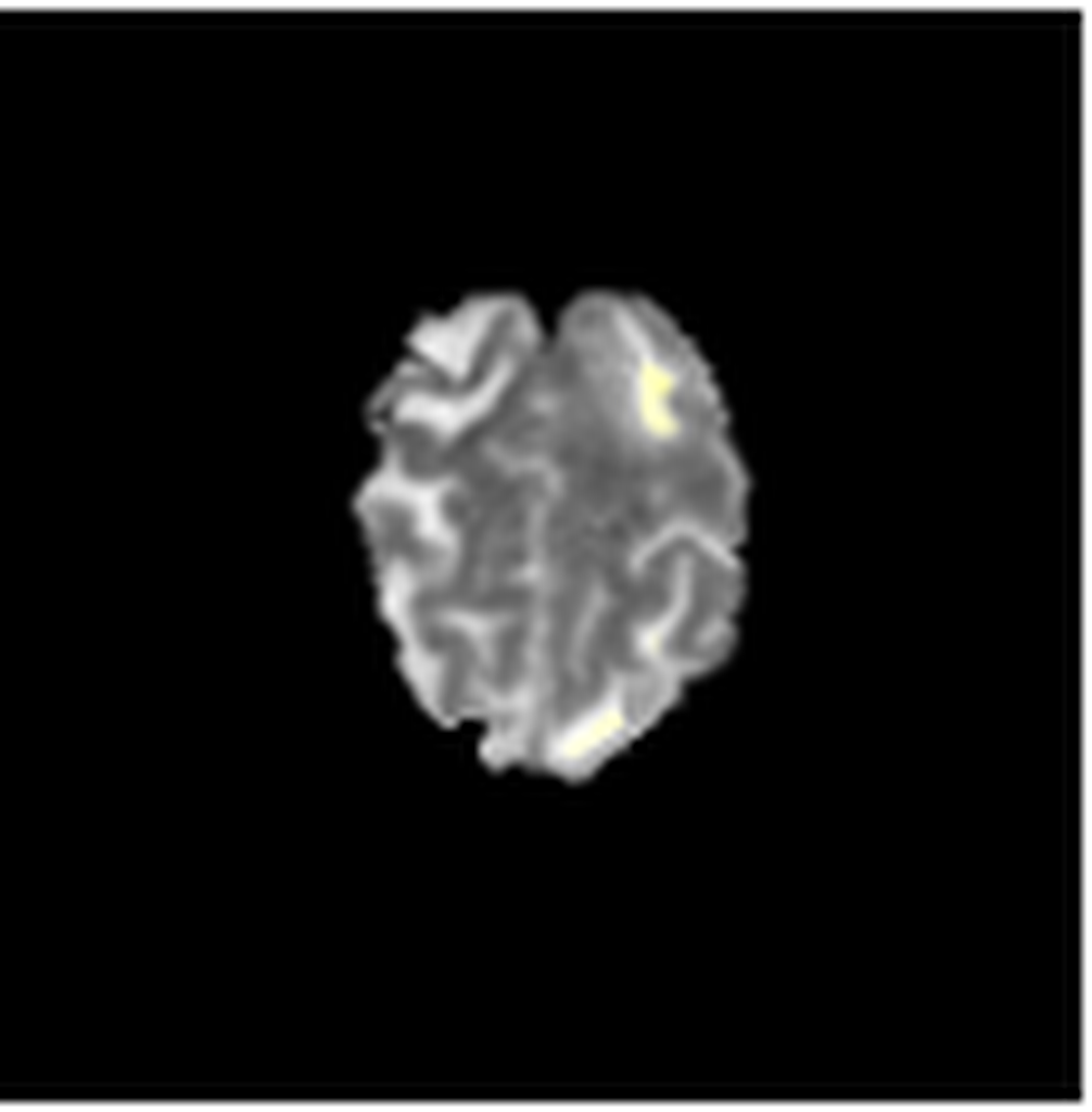 Original MR (Magnetic Resonance) Brain Tumor