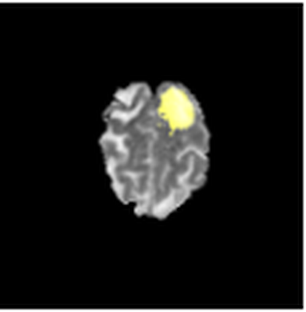 Segmented MR (Magnetic Resonance) Brain Tumor