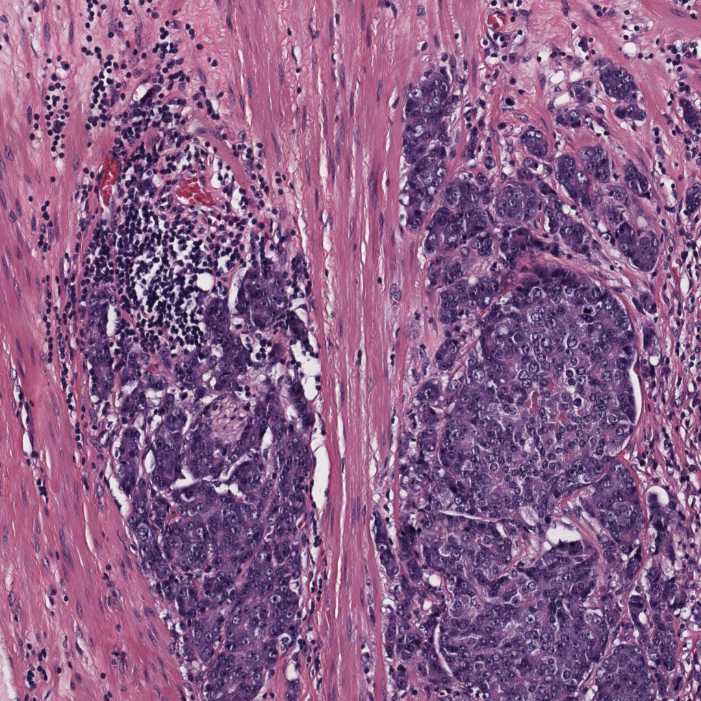 Original Pathology Arterioles