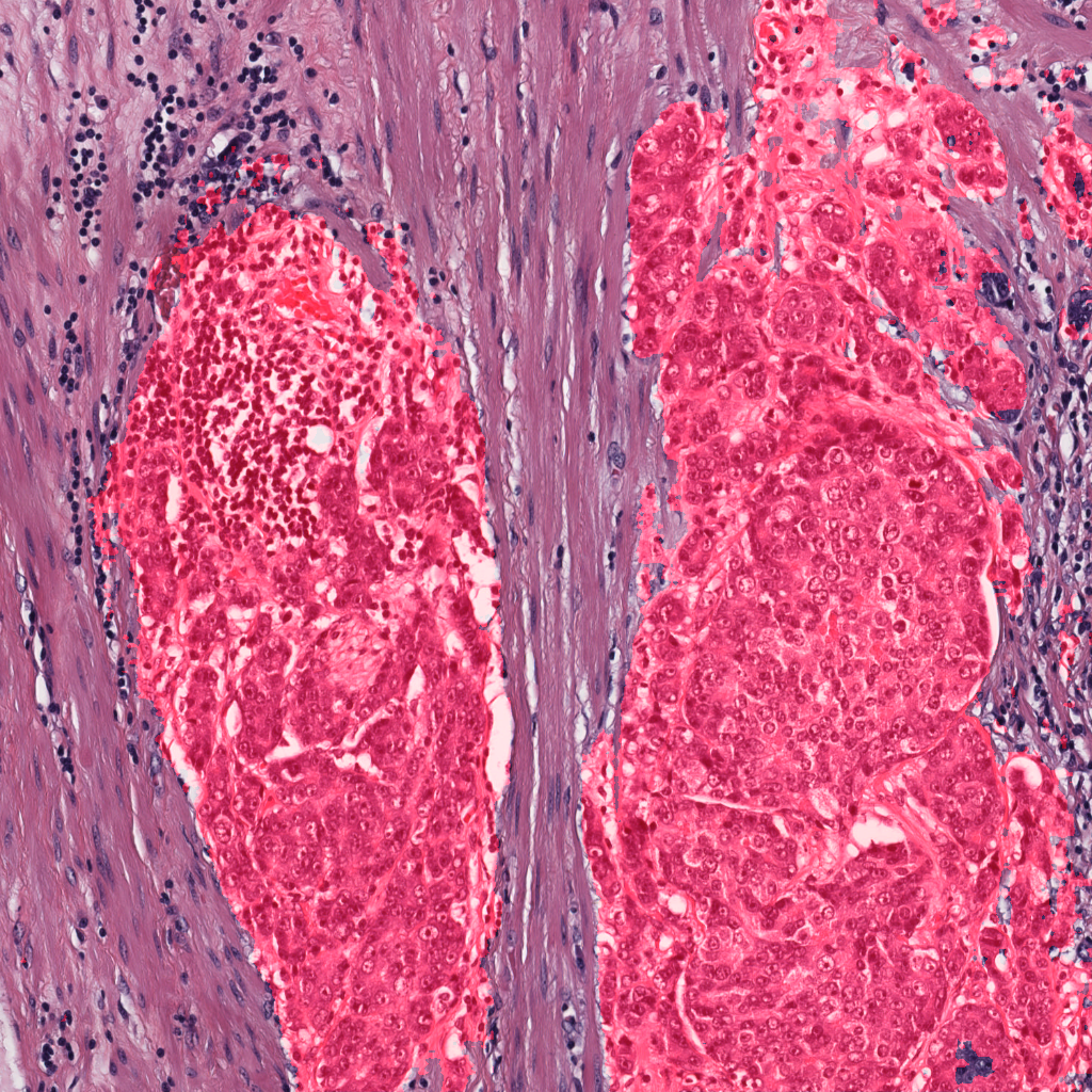 Segmented Pathology Arterioles