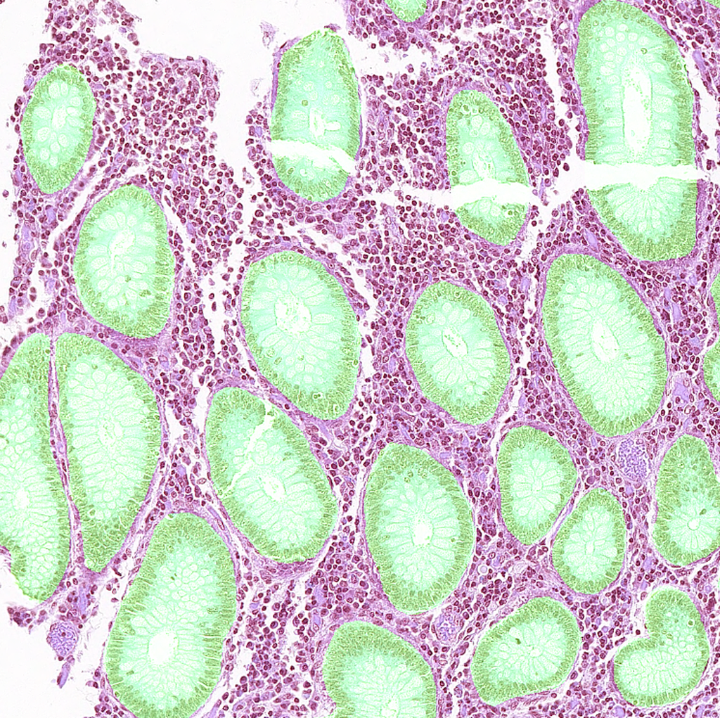 Segmented Pathology Gland