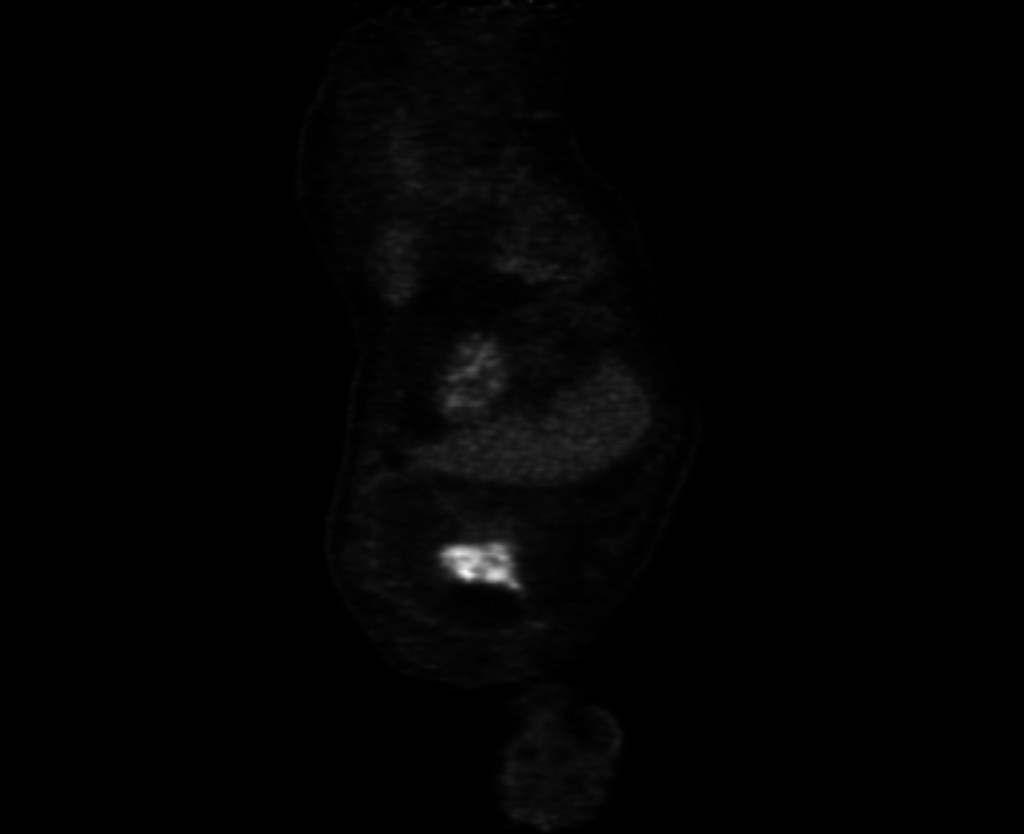 Original PET (Positron Emission Tomography) Lesion