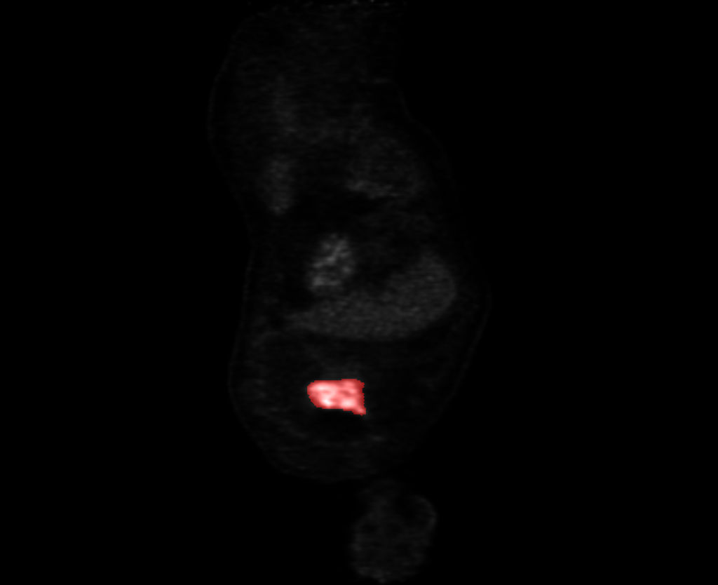 Segmented PET (Positron Emission Tomography) Lesion