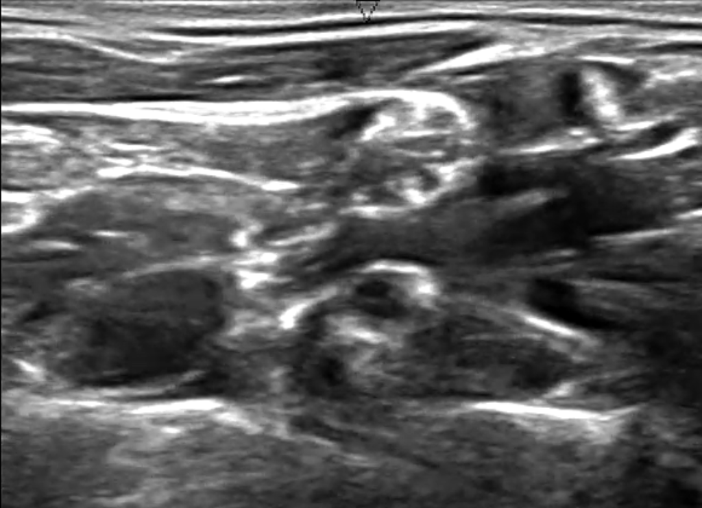Original Ultrasound Brachial Plexus