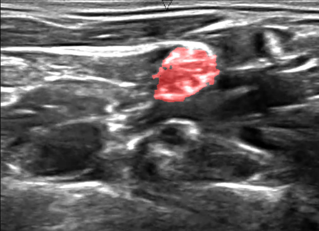 Segmented Ultrasound Brachial Plexus
