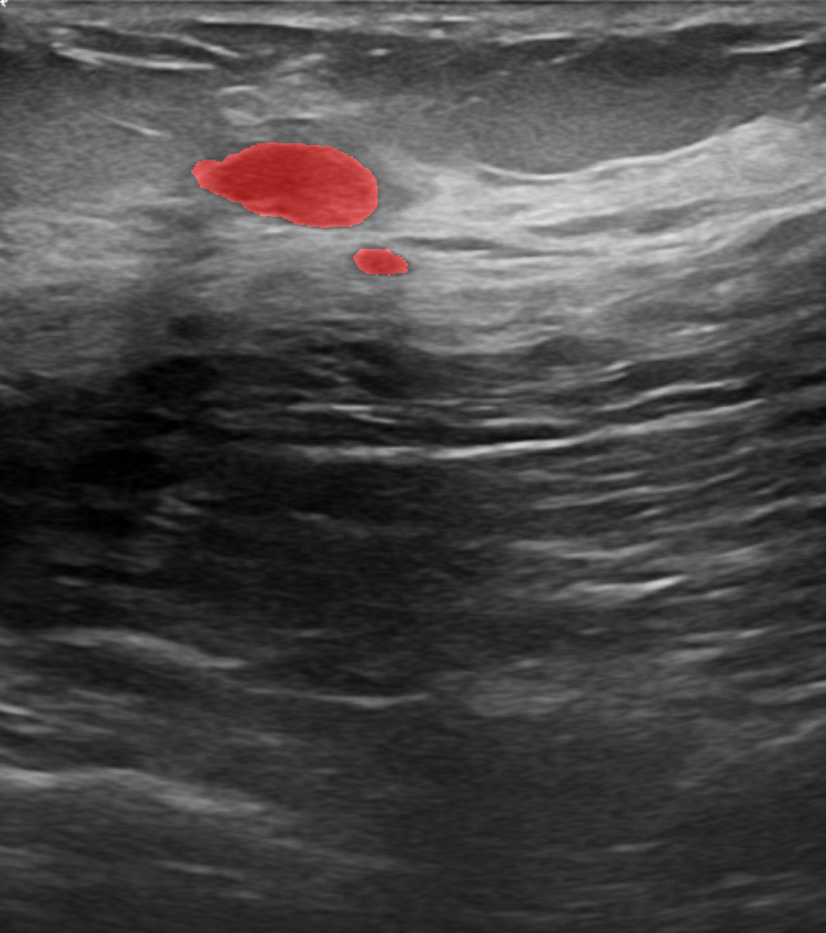 Segmented Ultrasound Breast Cancer