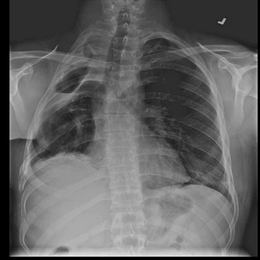 Original X-ray Pneumothorax