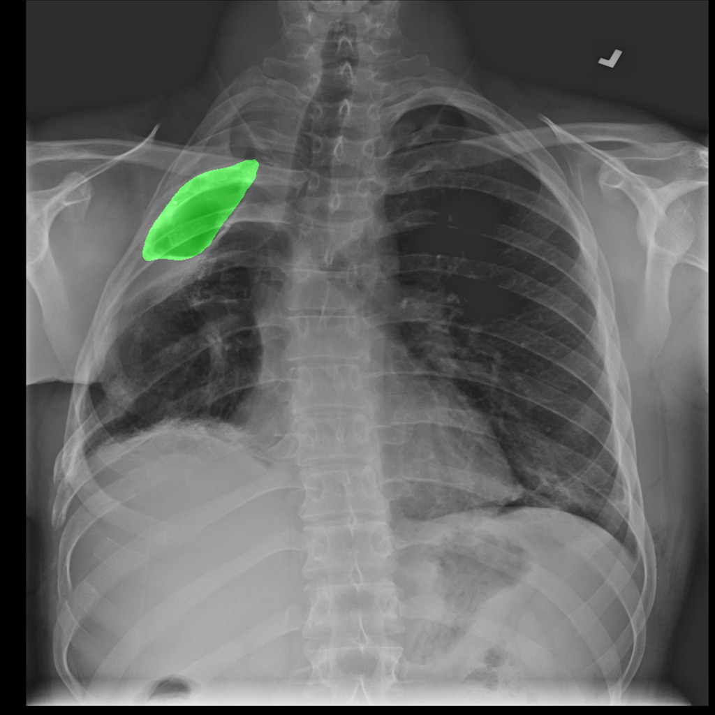 Segmented X-ray Pneumothorax